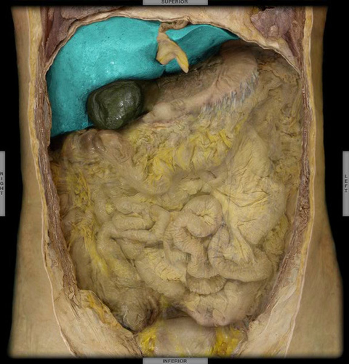 <p>A large solid organ that lies in the right upper quadrant immediately below the diaphragm; it produces bile, stores glucose for immediate use by the body, and produces many substances that help regulate immune responses.</p>