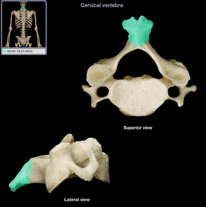 <ul><li><p>Location: Vertebrae (posterior aspect)</p></li><li><p>Description: Unpaired, posterior projection from midline of vertebral arch, Usually bifid</p></li></ul><p></p>