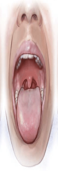 <p style="text-align: start"><span style="color: rgb(0, 0, 0)">Mallampati 2 score</span></p>