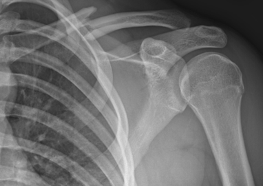 <p>clavicle fracture MOI</p>