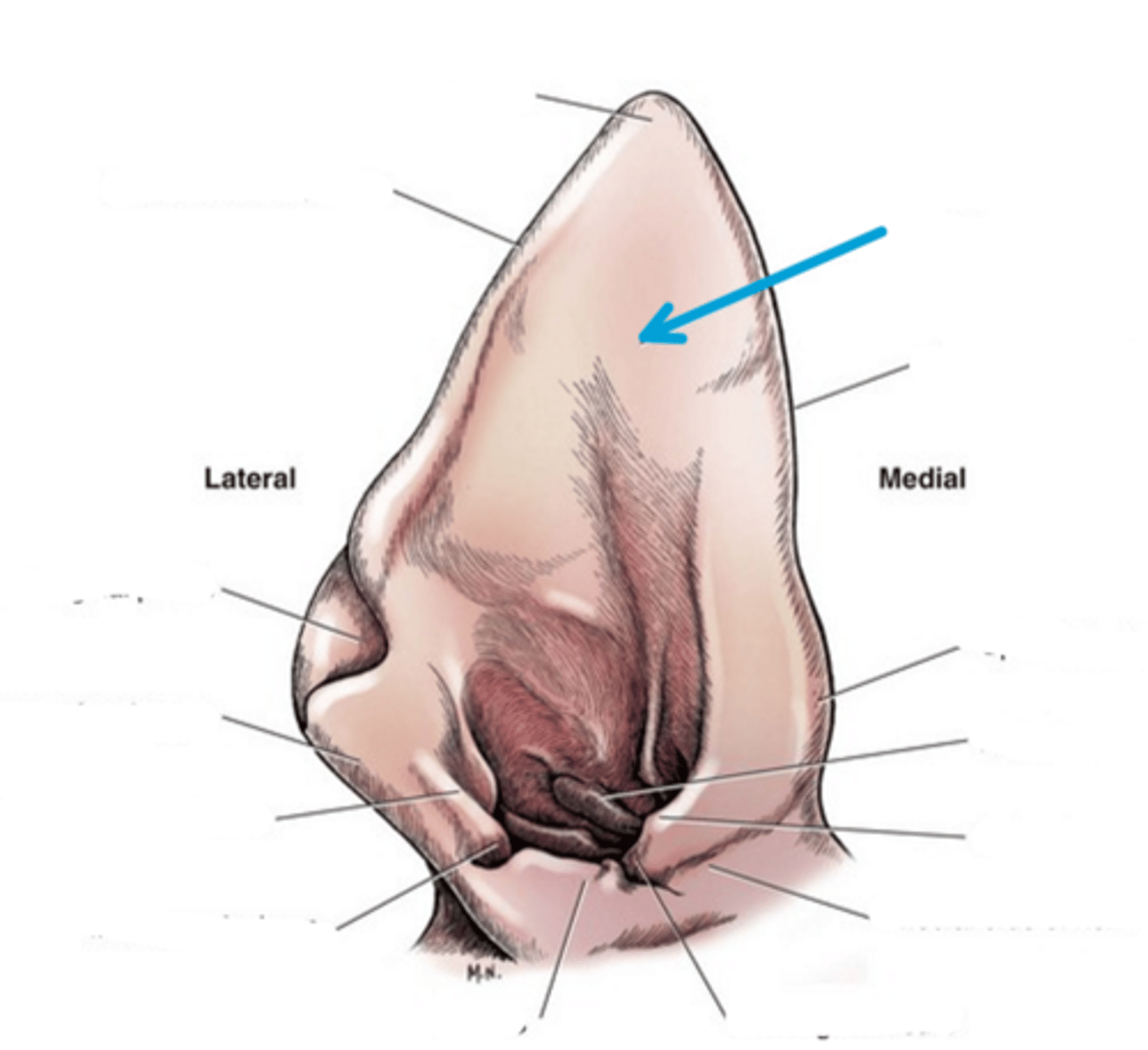 <p>soft, fluctuant swellings on the concave aspect of the scapha (sometimes extending into the ear canal)</p>