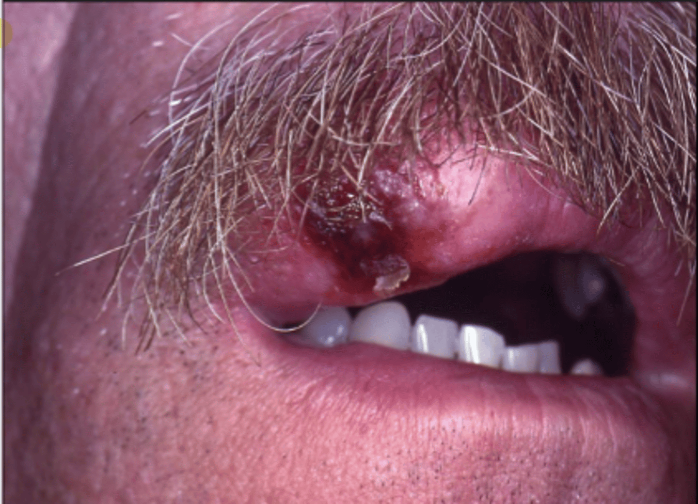 <p>In HIV positive patients, the lesions are more widespread and present with an a-typical pattern. They are treated with acyclovir</p>