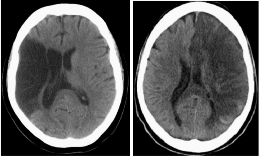 <p>Ischemic Stroke</p>