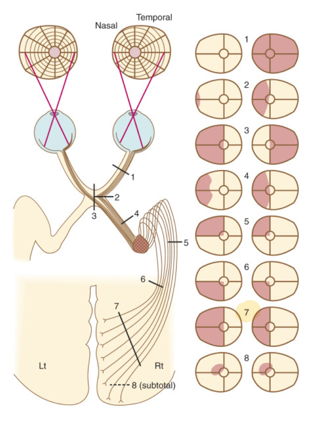 <p>Sindrome lobo occipital (direito ou esquerdo)</p>