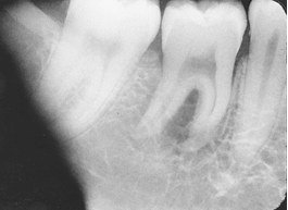 <p>What is the problem with this LIGHT LEAK X-ray?</p>