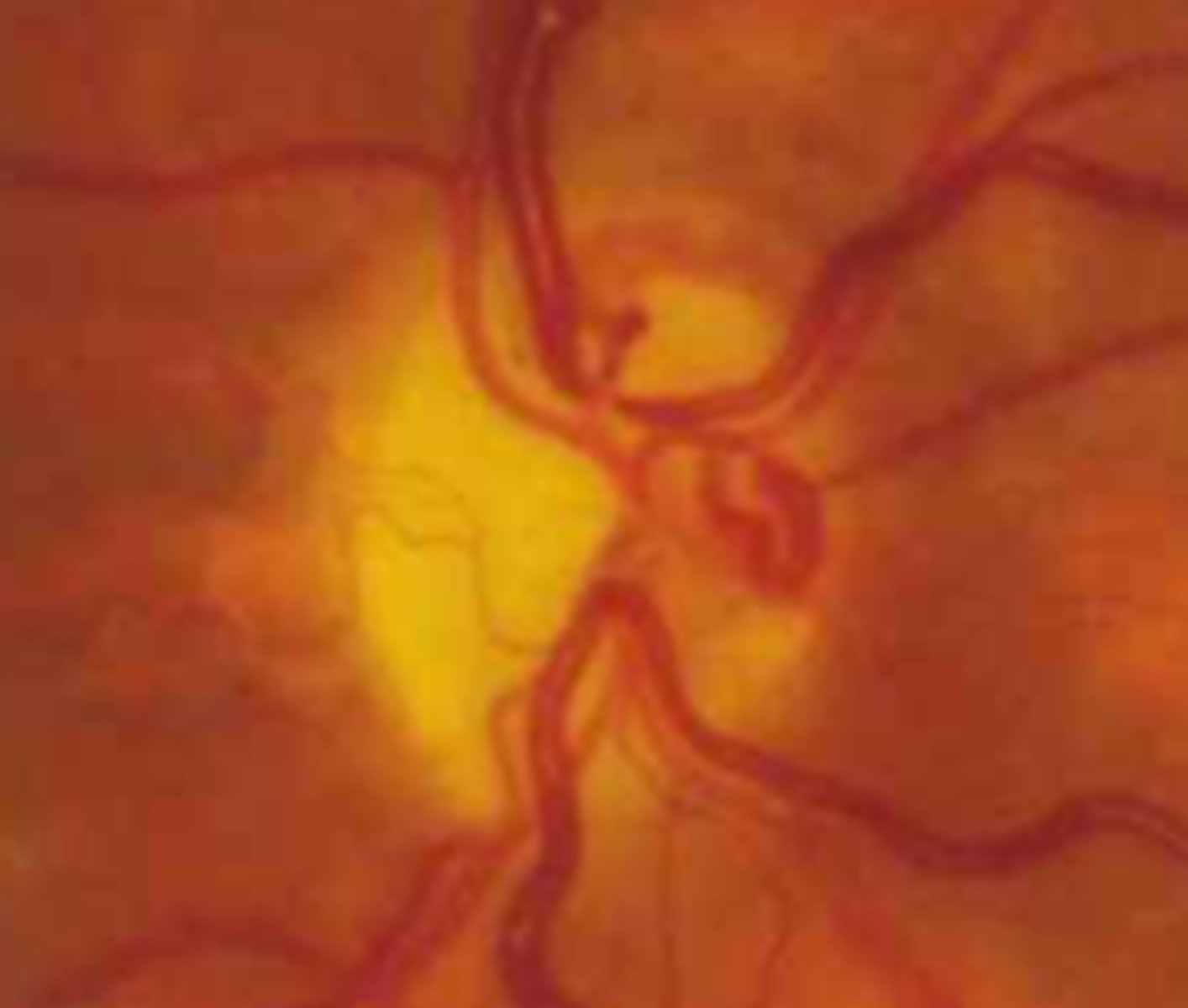 <p>sphenoid wing meningiomas</p><p>ON gliomas</p><p>ON arachnoid cysts</p><p>chronic OAG</p><p>ON drusen</p><p>CRAO</p><p>chronic papilledema</p><p>DM</p>