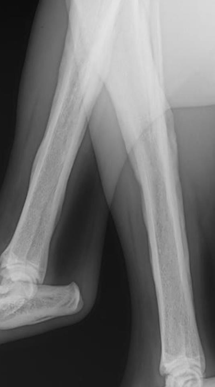 <p>treat underlying cause if possible</p><p>-primary lung tumor resection or metastasectomy (rapid resolution of symptoms)</p>
