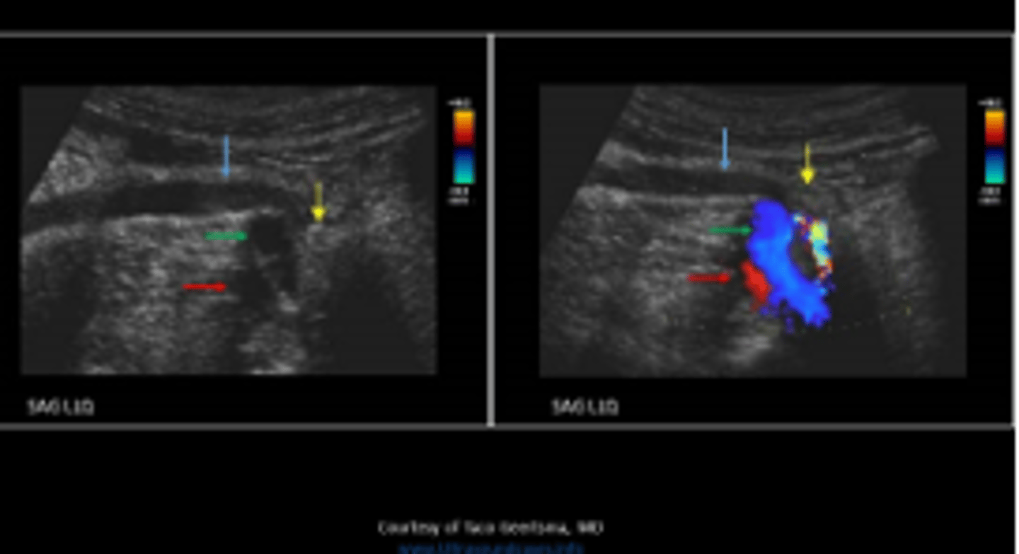 <p>Iliac artery</p>