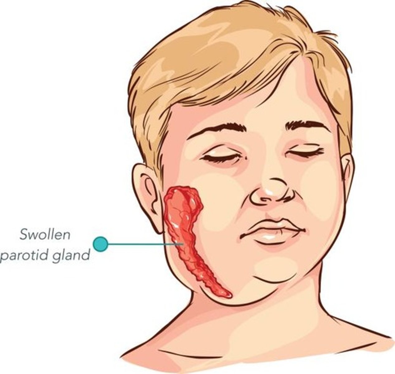 <p>Viral infection of salivary glands causing excessive swelling (mostly parotid glands)</p>