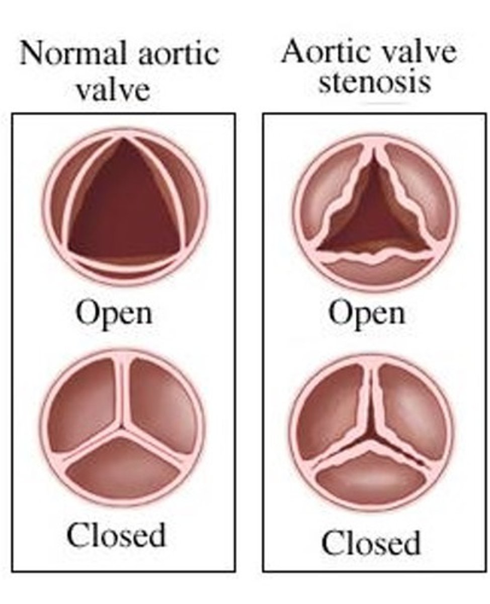 <p>- congenital, noncyanotic heart defect with narrowing of the aortic valve</p><p>- results in reduced LV output</p>