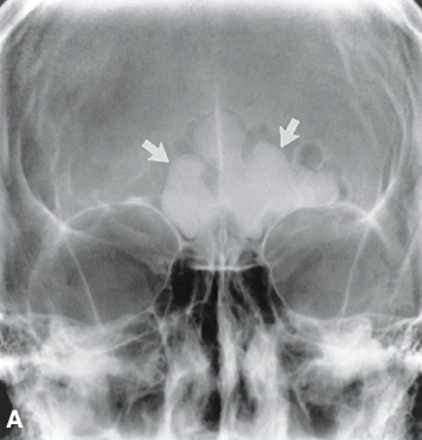 <p>benign tumor of bone, well-defined <strong>radiopaque</strong>, often asymptomatic, and can occur in various locations (MOST COMMON IN SINUS) including the jaw. </p>