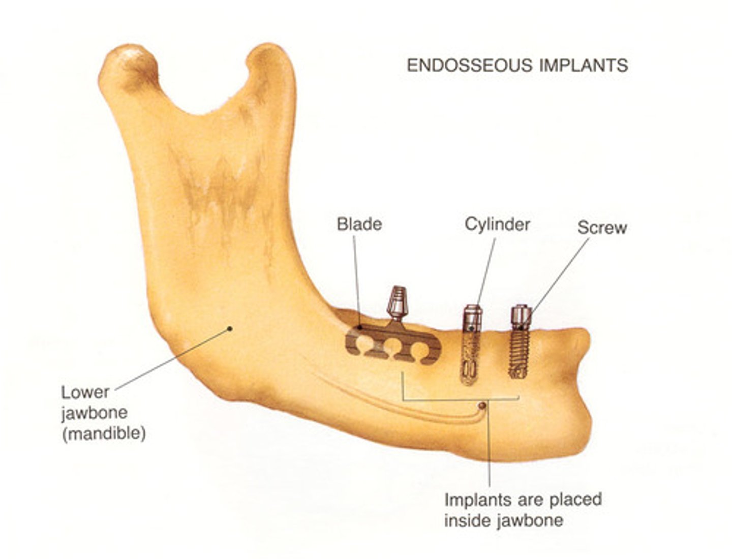 <p>placed within alveolar bone</p><p>based on concept of osseointegration</p><p>consists of 3 parts: fixture, abutment, prosthesis</p><p>most effective</p>
