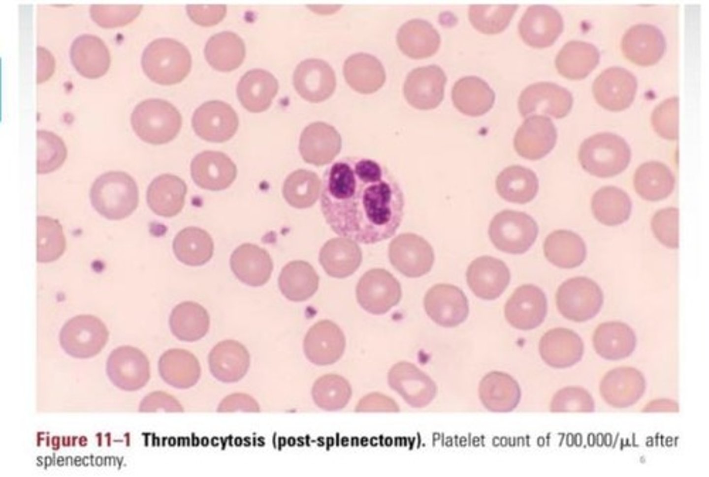 <p>Increased platelet count above 450,000 cells/mm³.</p>
