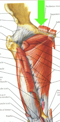 <p>O - Pubic Bone</p><p>I - Distal lesser Trochanter</p><p>A - Hip Flexion ADDuctor, Ext. Rotation</p><p>N - Femoral n.</p>