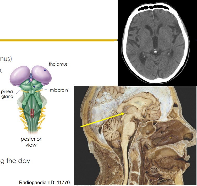 <p>- Posterior part of diencephalon (epithalamus)</p><p>- located in posterior wall of 3rd ventricle, midsagittal</p><p>Pinealocytes:</p><p>- synthesises melatonin from serotonin</p><p>- secretes melatonin rhythmically on 12 hour light/dark cycle</p><p>- directed by retinal light detection</p><p>- sympathetic stim. inhibits release during the day</p><p>- begins to calcify in your 30s</p><p></p><p>- increase melatonin makes you sleep</p>