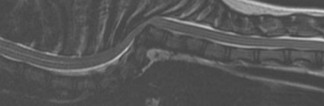 <ul><li><p>L7-S1 mosy common</p></li><li><p><strong>MOA:</strong> segment failure or trama</p><ul><li><p><strong>transition, butterfly, block, wedge, hypoplasia (pugs/frenchies), hemivertebra</strong></p></li><li><p>Scoliosis, lordosis, kyphosis: brachiocephalic breeds</p></li><li><p><u>young T3-L3 myelopathy</u> or old w/ multi disk injuries</p></li></ul></li><li><p><strong>CS:</strong> paraspinal discomfort, <strong>paresis, plegia, incontinence</strong>, <strong>ataxia</strong></p><ul><li><p><u>UMN signs</u></p></li></ul></li><li><p><strong>ID:</strong> <u>MRI</u>, rads</p></li><li><p><strong>Tx: </strong>NSAID, gabapentin, sx stabilization</p><ul><li><p>gliosis/atrophy of spinal cord = guarded the prognosis,</p></li></ul></li><li><p><strong>Facet hypoplasia</strong>: <u>Recurrent concussive injury leading to scar tissue w/in spinal cord (pugs, frenchies)</u></p></li></ul><p></p>