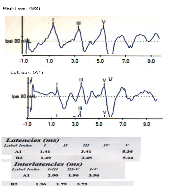 <p><span style="background-color: transparent;"><span>Review the left and right ABR waveform and latency indices obtained from a 31-yr female to assess neurological status.</span></span></p><p><span style="background-color: transparent;"><span>Provide the ABR interpretation of the data for both ears and what are the reasons behind your interpretation.</span></span></p><p><span style="background-color: transparent;"><span>FYI:&nbsp;</span></span></p><p><span style="background-color: transparent;"><span>Normative adult values:</span></span></p><ul><li><p><span style="background-color: transparent;"><span>Wave I: ~1.5 ms</span></span></p></li><li><p><span style="background-color: transparent;"><span>Wave III: ~3.5 ms</span></span></p></li><li><p><span style="background-color: transparent;"><span>Wave V: ~5.5 ms</span></span></p></li><li><p><span style="background-color: transparent;"><span>I–III IPL: ~2.3–2.4 ms</span></span></p></li><li><p><span style="background-color: transparent;"><span>III–V IPL: ~2.2–2.3 ms</span></span></p></li><li><p><span style="background-color: transparent;"><span>I–V IPL: ~4.4–4.5 ms</span></span></p></li></ul><p></p>