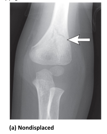 <p>the fragments of the fracture are still aligned</p>