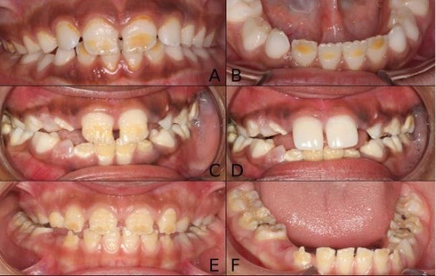 <p>The following are oral manifestations of a deficiency in what vitamin?</p><p>•Severe early childhood caries</p><p>•Periodontal disease</p><p>•Enamel chronological hypoplasia</p>