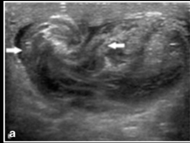 <p>Testicular Torsion</p>