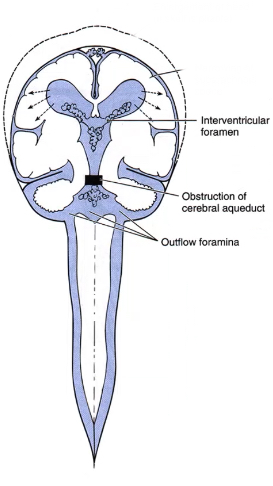 <p>typically due to congenital aqueductal stenosis/blockage of ventricular system</p><p>structures superior to blockage dilate (and skull in infants bc it isn’t fully calcified yet)</p><p>enlarged head (if skull is pliable)</p><p>narrowing of subarachnoid space</p>