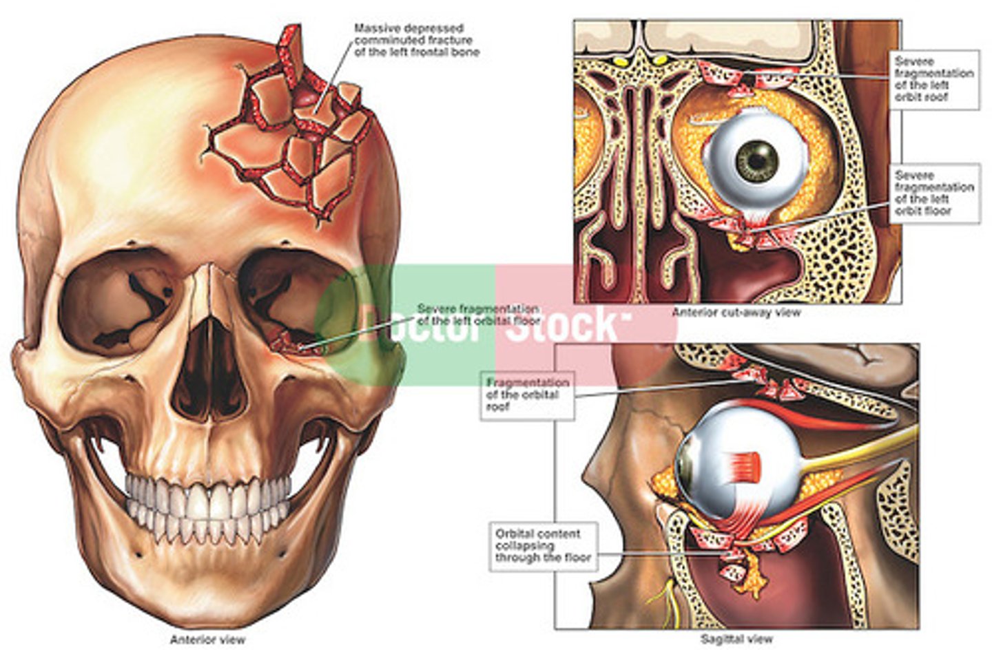 <p>Multiple associated linear fractures; usually result from intense impact such as repeated blows against an object; may suggest child maltreatment</p>