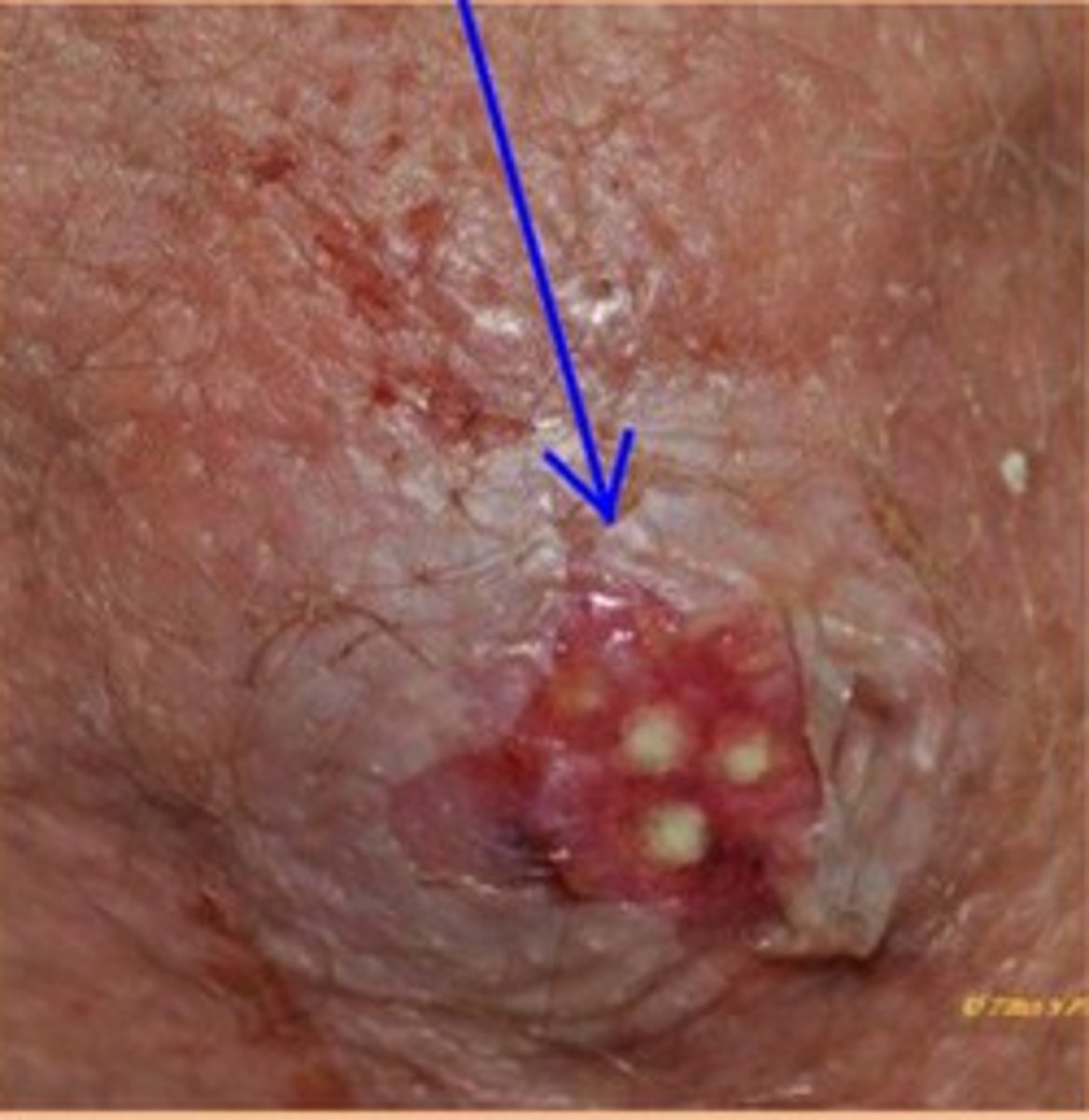 <p>diagnose this image</p><p>this is a superficial inflammatory mass consisting of several inflamed hair follicles and multiple sites of drainage→ in the epidermis</p>