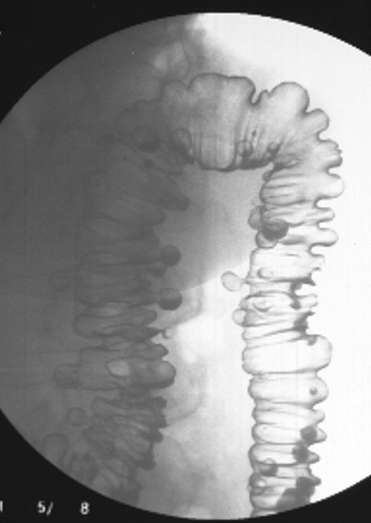 <p>What causes diverticula to form?</p>