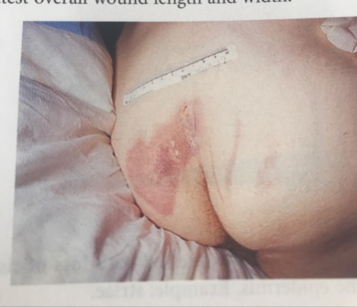 <p>Pressure Injuries: Stage</p>