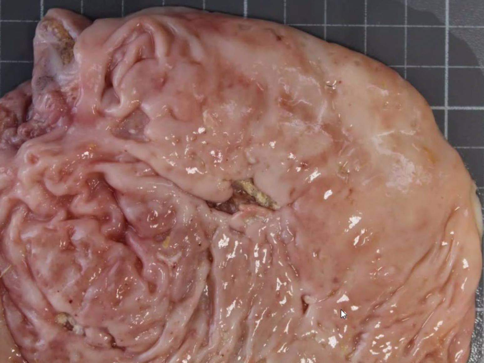 <p>What is another organ affected?</p><p>1-Brain</p><p>2-Lung</p><p>3-0vary</p><p>4-Uterus</p>