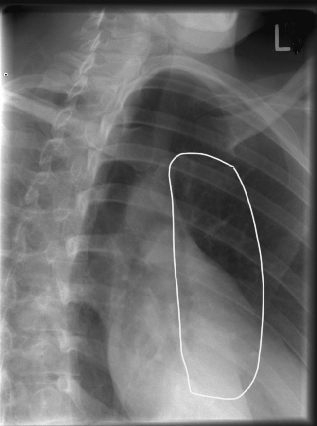 <p>Sternum lateral to heart shadow, foreshortened.</p>