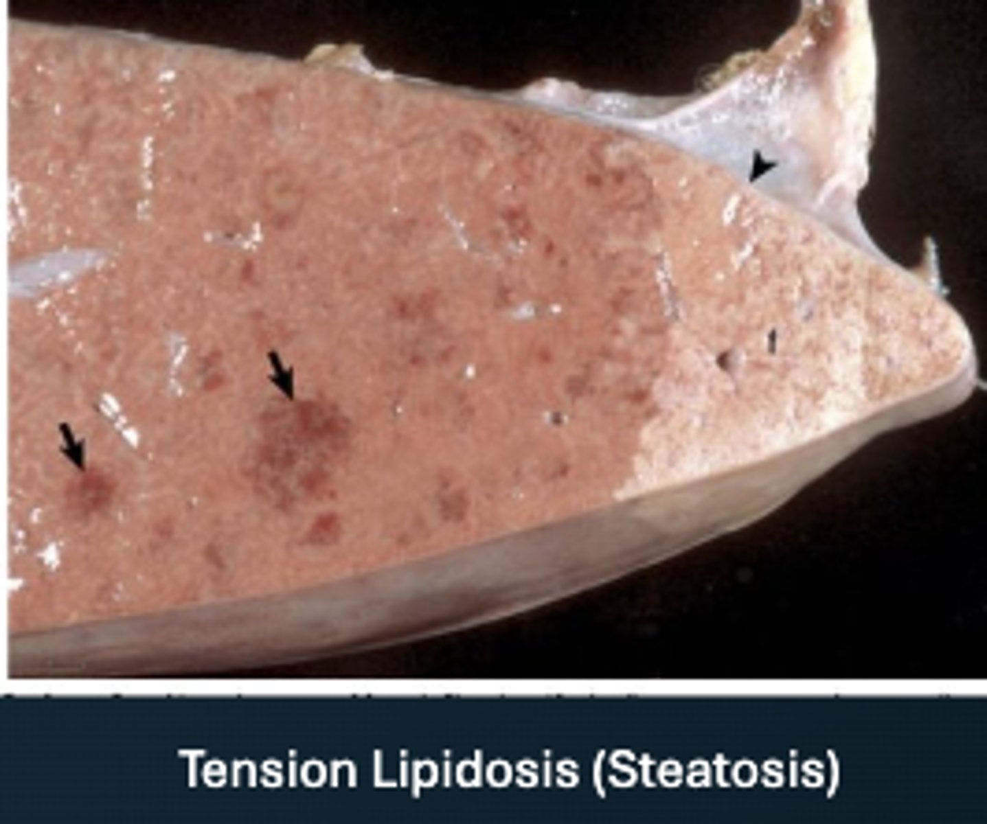 <p>What has caused this gross appearance of this liver?</p>