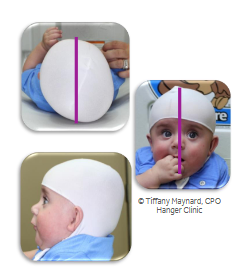 <p>Rating scale based on <strong><em>visual </em></strong>assessment criteria.</p><p>Posterior Lateral Cranial Asymmetry </p><ul><li><p>Type I - Posterior Asymmetry </p></li><li><p>Type II - Ear Malpositions </p></li><li><p>Type III - Frontal Asymmetry </p></li><li><p>Type IV - Facial Asymmetry </p></li><li><p>Type V - Temporal Bossing or Posterior Vertical Growth</p></li></ul><p></p>