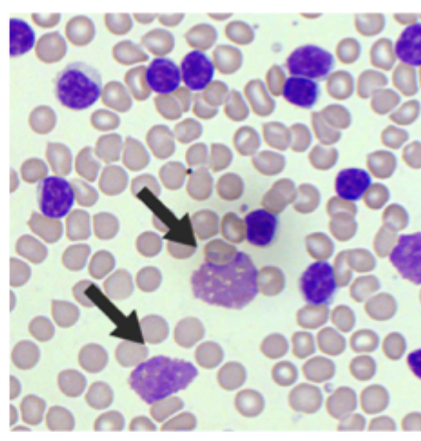 <p>Diagnostics for CLL</p>