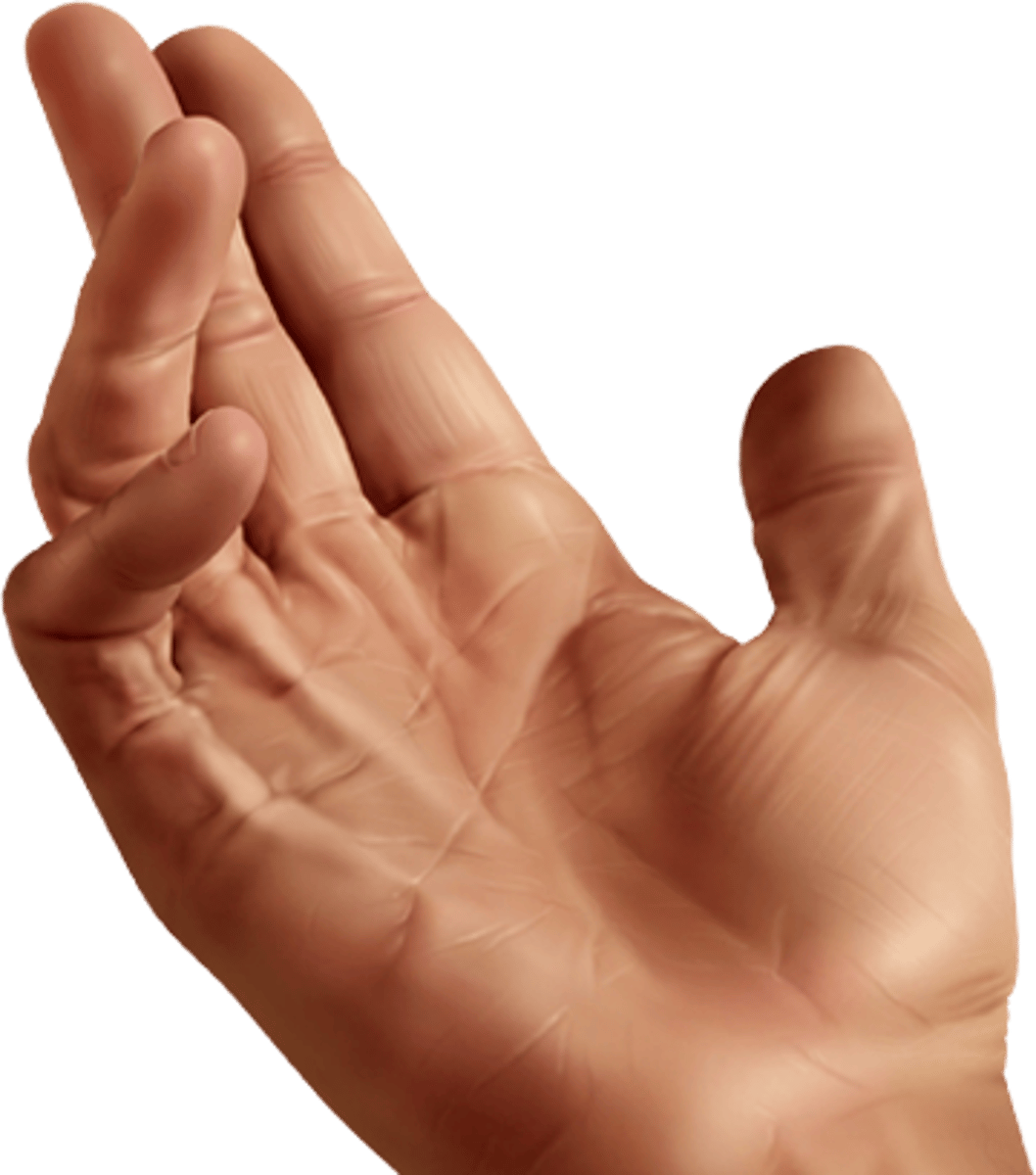 <p>contracture of palmar fascia, fixed flexion deformity of MCP & PIP</p><p>usually seen in ring or little finger</p><p>affects men more than women.</p>