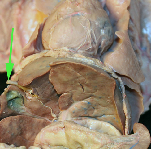 <p><span>The stub of vessel marked by the green arrow is the</span><br><span> <strong>umbilical</strong> vein.</span></p>