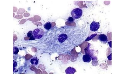 <p><span style="font-family: Helvetica; font-size: 12px;">Of the following, the disease most closely associated with glucocerebrosidase deficiency and characterized by the cell type shown here is:</span></p>