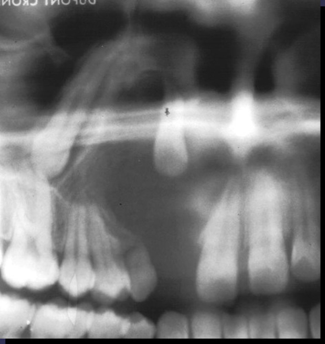 <p>What category would you put this lesion into?</p>