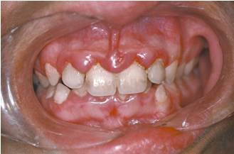 <ul><li><p>effects both epithelium and lamina propria </p></li><li><p>overgrowth of interproximal gingiva caused by the intake of certain drugs for seizure control, certain antibiotics, and specific hear medications</p></li></ul><p></p>