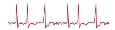 <p>What is <strong>atrial fibrillation</strong>?</p>