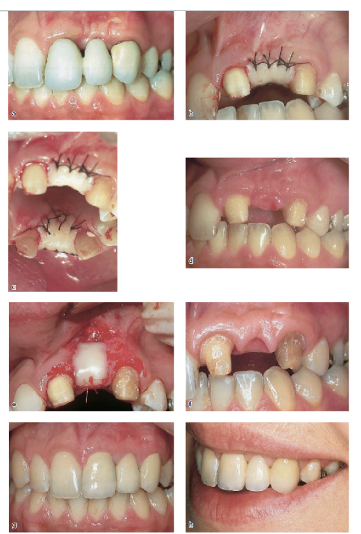 <p>soft tissue grafts</p><ul><li><p>pedicle graft procedure: roll flap procedure </p></li><li><p>free graft procedure: pouch graft procedure, interpositional graft procedure, onlay graft procedure </p></li></ul><p></p>