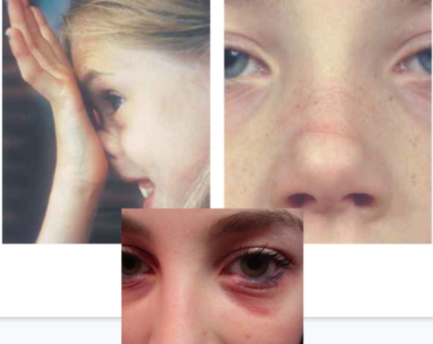 <p>Nasal mucosa pale and boggy</p><p>Conjunctiva congested and edematous</p><p>Nasla polyps</p><p>Cobblestoning </p><p>Allergic “shiners”</p><p>Allergic “salute”</p>