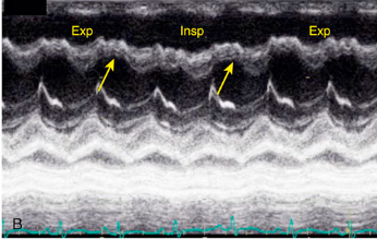 <p>What is the arrow pointing to?</p><p>What condition is this finding demonstrated in?</p>