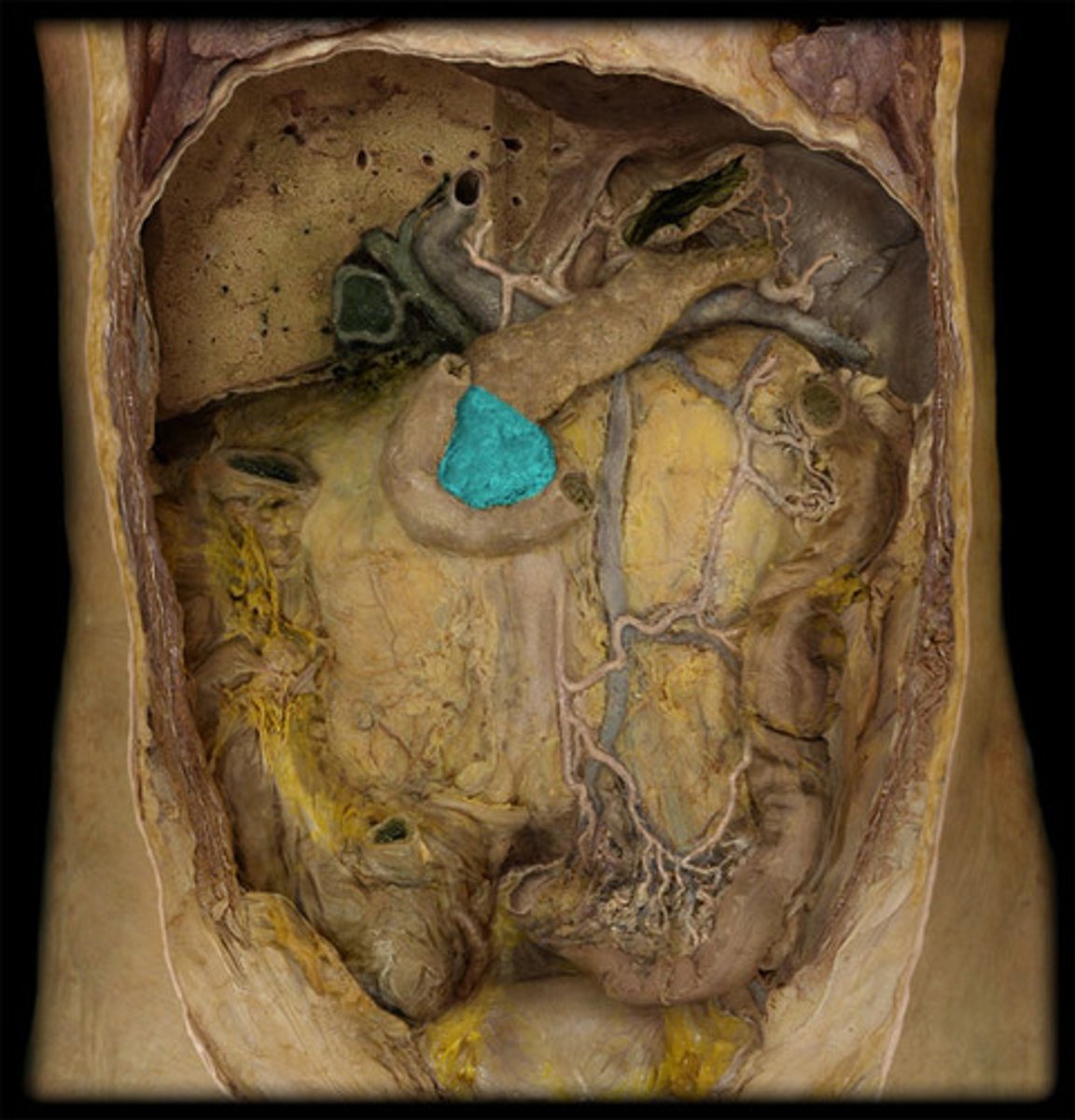 <p>The wider part of the pancreas that is adjacent to the duodenum.</p>