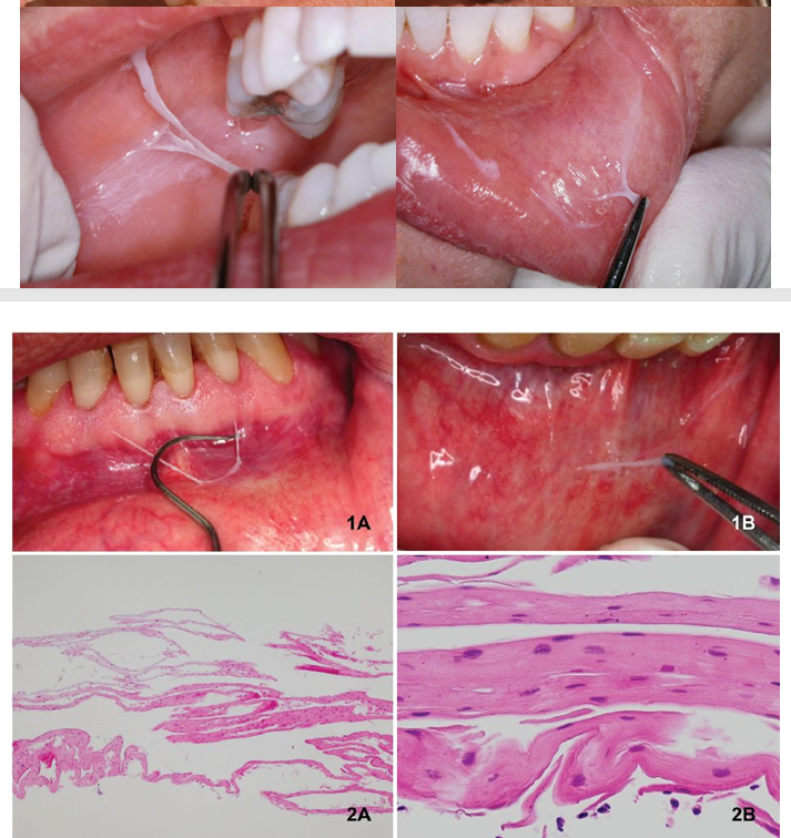 <p>-thready white fragments on top of (nonkeratinized) mucosa- easily peel off</p><p>-contact with irritants that are not strong enough to cause ulceration or necrosis- alcoholic mouth rinses, strong toothpastes</p><p>-no tx necessary</p><p>-may counsel pt to change products</p>