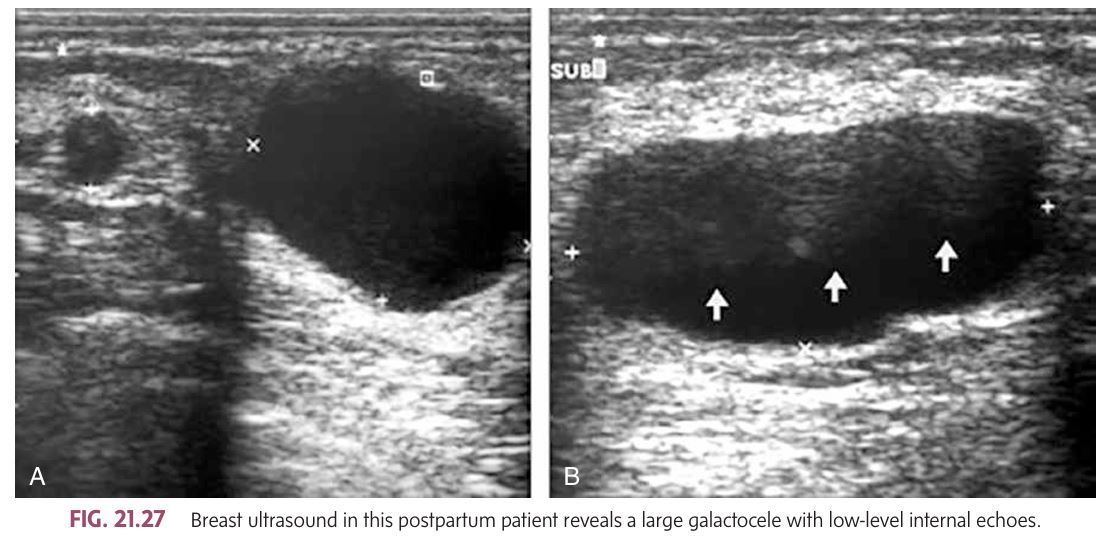 <p></p><ul><li><p class=""><strong>Most common mass during pregnancy/lactation</strong>: <strong>Fibroadenomas</strong>.</p><ul><li><p class=""><strong>Reason for growth</strong>: Increased hormone levels during pregnancy and lactation can cause fibroadenomas to enlarge rapidly.</p></li><li><p class=""><strong>Note</strong>: The hormonal surge can also affect <strong>breast cancers</strong>, which might be diagnosed later than in non-pregnant women.</p></li></ul></li></ul><p> <strong>Other Breast Issues During Pregnancy/Lactation</strong>: </p><ul><li><p class=""><strong>Mastitis</strong></p></li><li><p class=""><strong>Abscesses</strong></p></li><li><p class=""><strong>Cysts</strong></p></li><li><p class=""><strong>Galactoceles</strong> (milk-filled cysts).</p><ul><li><p class=""><strong>Galactocele Appearance</strong>: May appear as a <strong>complex cyst</strong> on mammography or ultrasound, or sometimes show a <strong>fat-fluid level</strong>.</p></li><li><p class=""><strong>Treatment</strong>: Cysts (including galactoceles) can be <strong>aspirated</strong> under ultrasound guidance.</p></li></ul></li></ul><p></p>