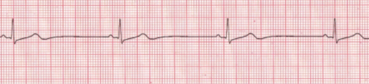 <p>Determine the sinus node arrhythmia:</p><p>slower-than-normal heart rate, usually &lt;60 bpm, but rhythm remains regular</p><p></p>