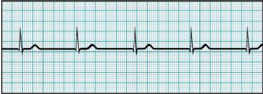 <p>Which feature is absent in the ECG tracing above?</p><p>a. T wave b. QRS complex c. V wave d. P wave e. none of these, the patient is normal</p>