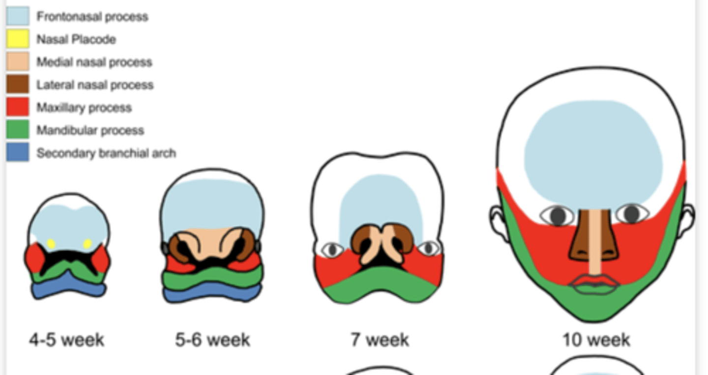 <p>What is the cause of cleft lip? </p>