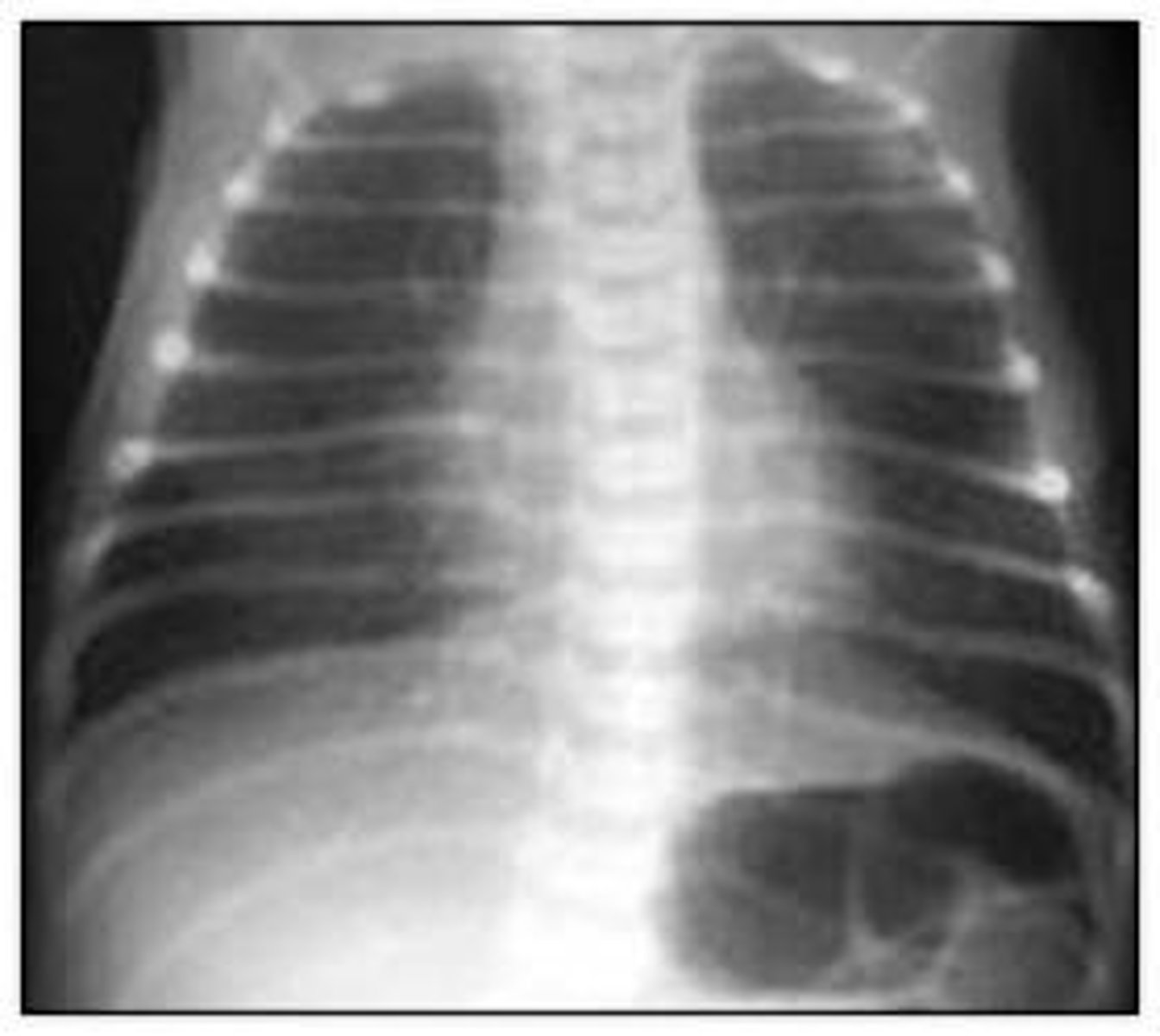 <p>38 wk LGA infant born by C/S to an A2GDM has dyspnea/grunting</p><p>- Pathophys?</p><p>- Prognosis?</p>